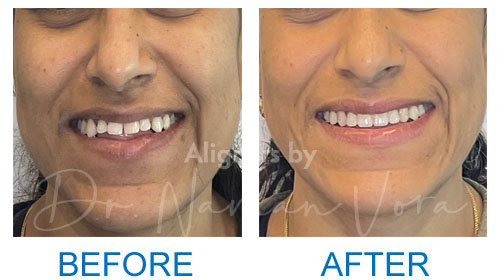 Aligning smile curve