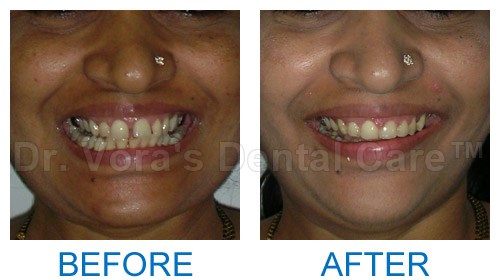 Adult teeth correction