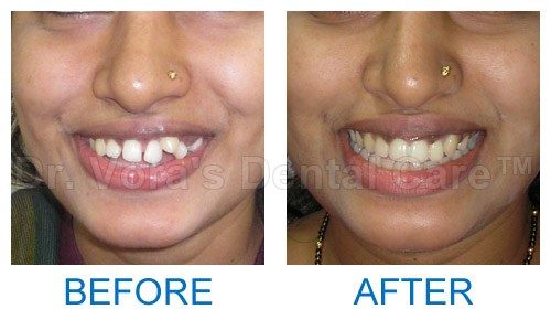 Adult teeth correction