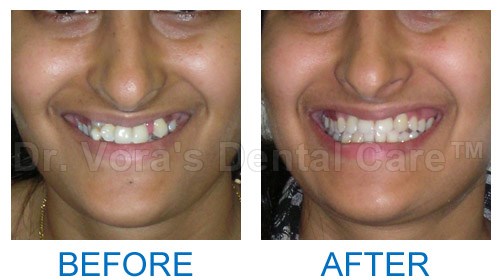 Crocket teeth correction