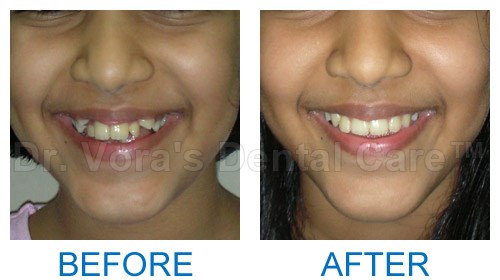 Crocket teeth correction