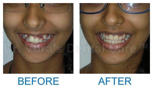 Crocket teeth correction