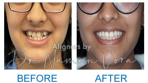 Crowded teeth correction