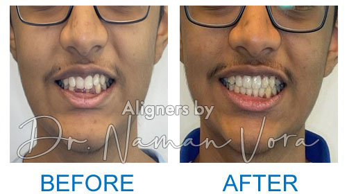 Deep Bite correction