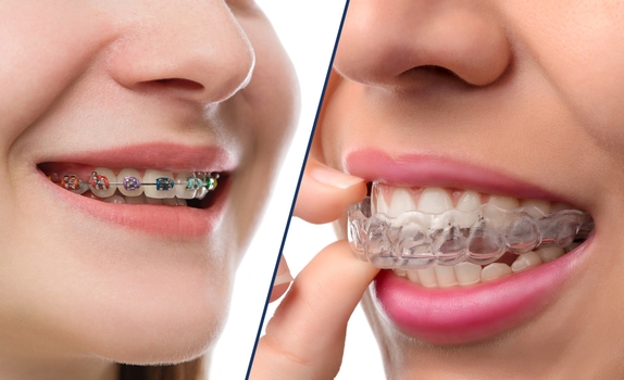 Invisalign