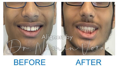 Lower Jaw Advancement