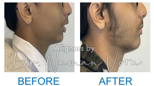 Lower Jaw Advancement