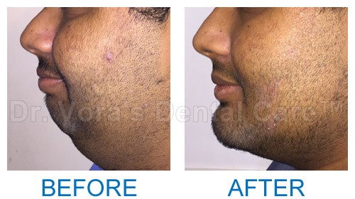 Surgical jaw correction