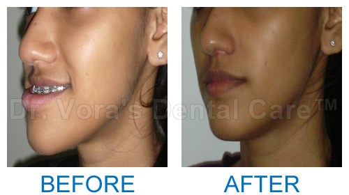 Surgical jaw correction