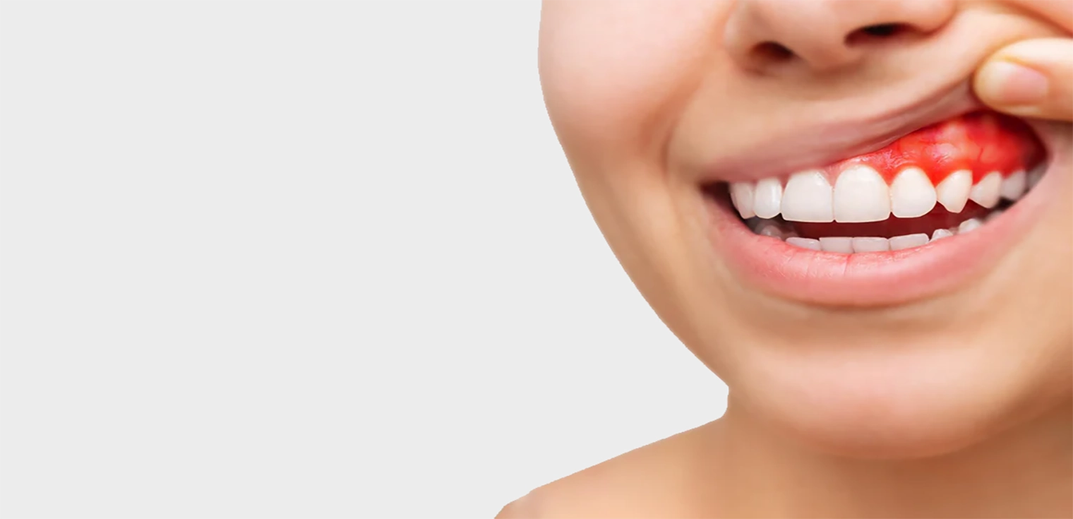 Gum Disease Treatment