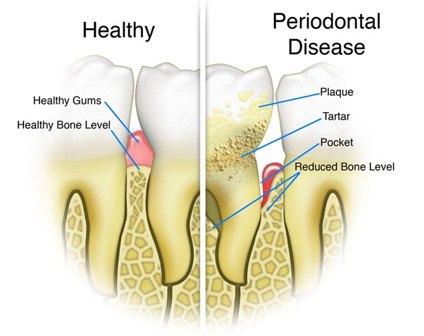 gumd12 Gum Disease